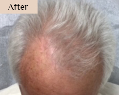 injections for hair loss treatment - before and after results